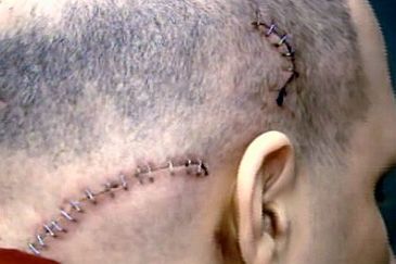 Joseph Lozito's injuries on his head